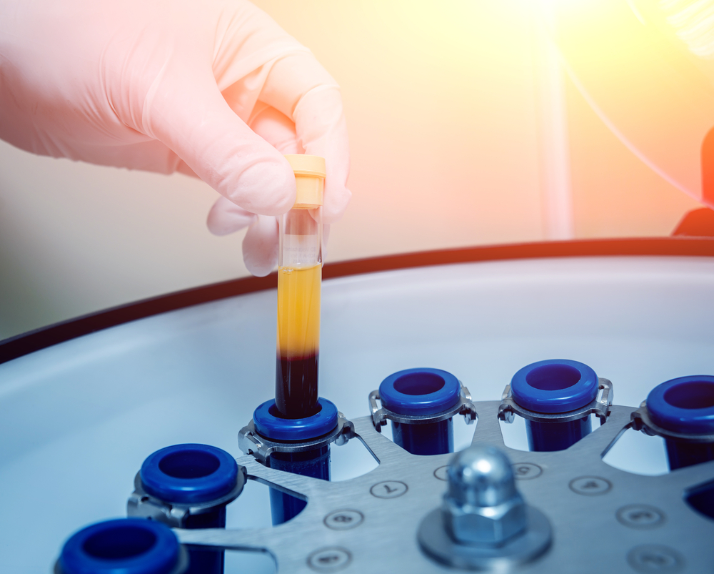 Recovered COVID-19 Patients Urged to Donate Blood Plasma to Help Existing Patients