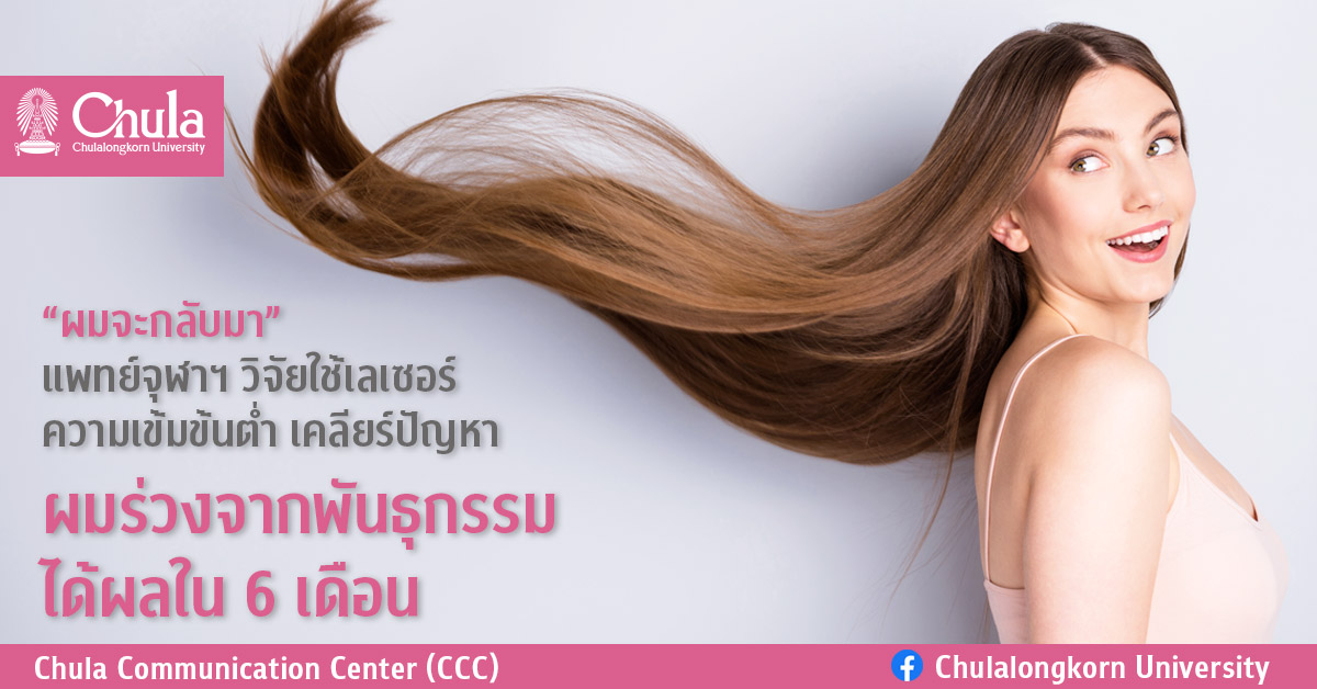 “ผมจะกลับมา” แพทย์จุฬาฯ วิจัยใช้เลเซอร์ความเข้มข้นต่ำ เคลียร์ปัญหาผมร่วงจากพันธุกรรมได้ผลใน 6 เดือน