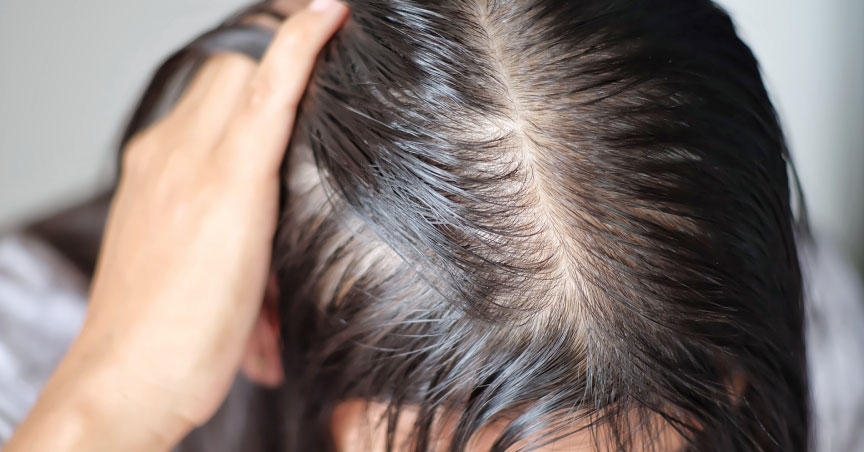 Low-Level Laser Treatment Can Stimulate Hair Follicles and Hair Growth, Chula Expert Finds