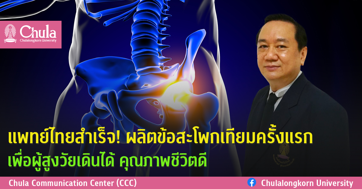 แพทย์ไทยสำเร็จ! ผลิตข้อสะโพกเทียมครั้งแรก เพื่อผู้สูงวัยเดินได้ คุณภาพชีวิตดี