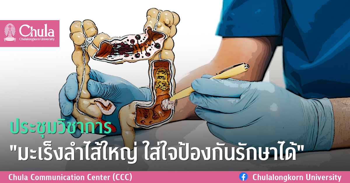 ประชุมวิชาการ “มะเร็งลำไส้ใหญ่ ใส่ใจป้องกันรักษาได้”