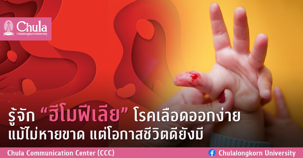รู้จัก “ฮีโมฟีเลีย” โรคเลือดออกง่าย แม้ไม่หายขาด แต่โอกาสชีวิตดียังมี
