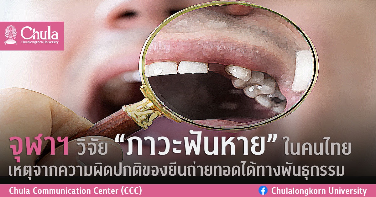 จุฬาฯ วิจัย “ภาวะฟันหาย” ในคนไทย เหตุจากความผิดปกติของยีนถ่ายทอดได้ทางพันธุกรรม