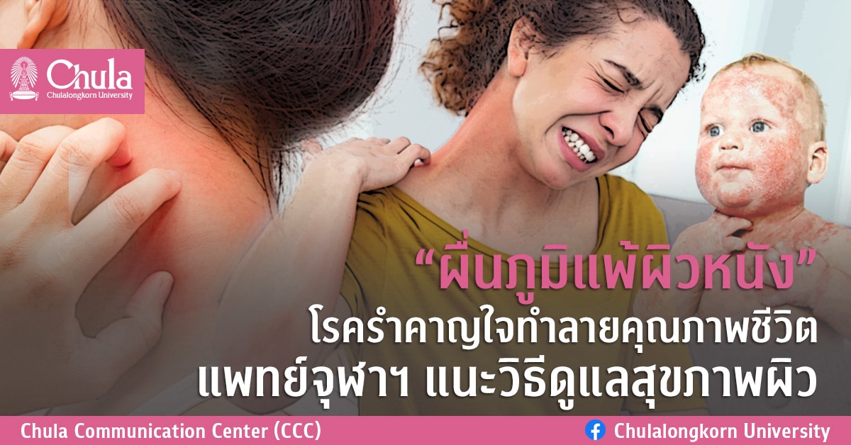 “ผื่นภูมิแพ้ผิวหนัง” โรครำคาญใจทำลายคุณภาพชีวิต แพทย์จุฬาฯ แนะวิธีดูแลสุขภาพผิว