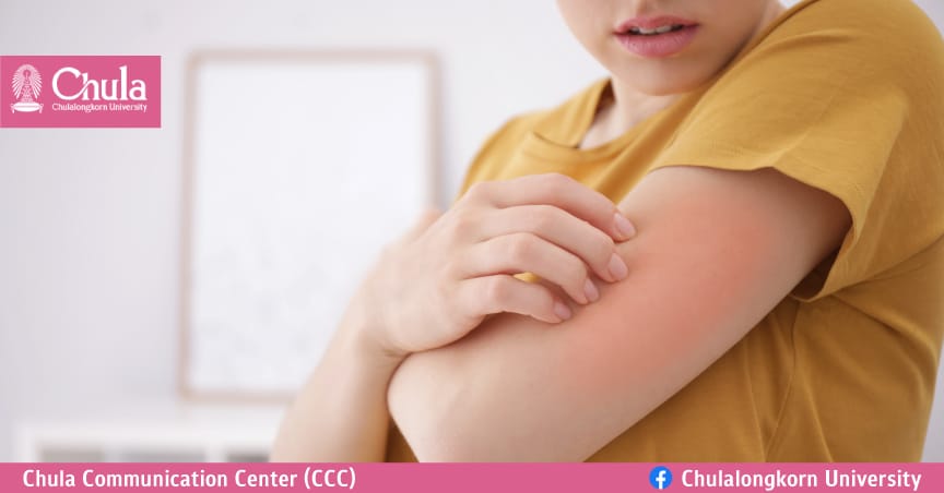 ผื่นภูมิแพ้ผิวหนัง โรครำคาญใจ แพทย์จุฬาฯ แนะวิธีดูแลสุขภาพผิว