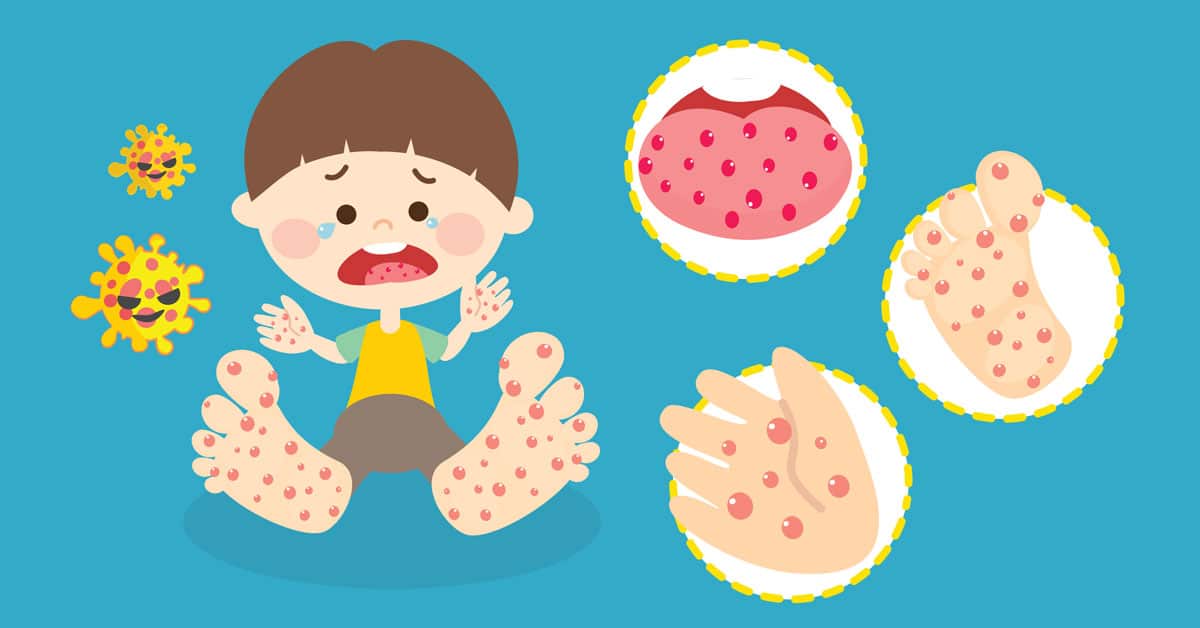 Thailand Must Prepare for More Dangerous EV-A71 HFMD Virus, Warns Chula Virologist