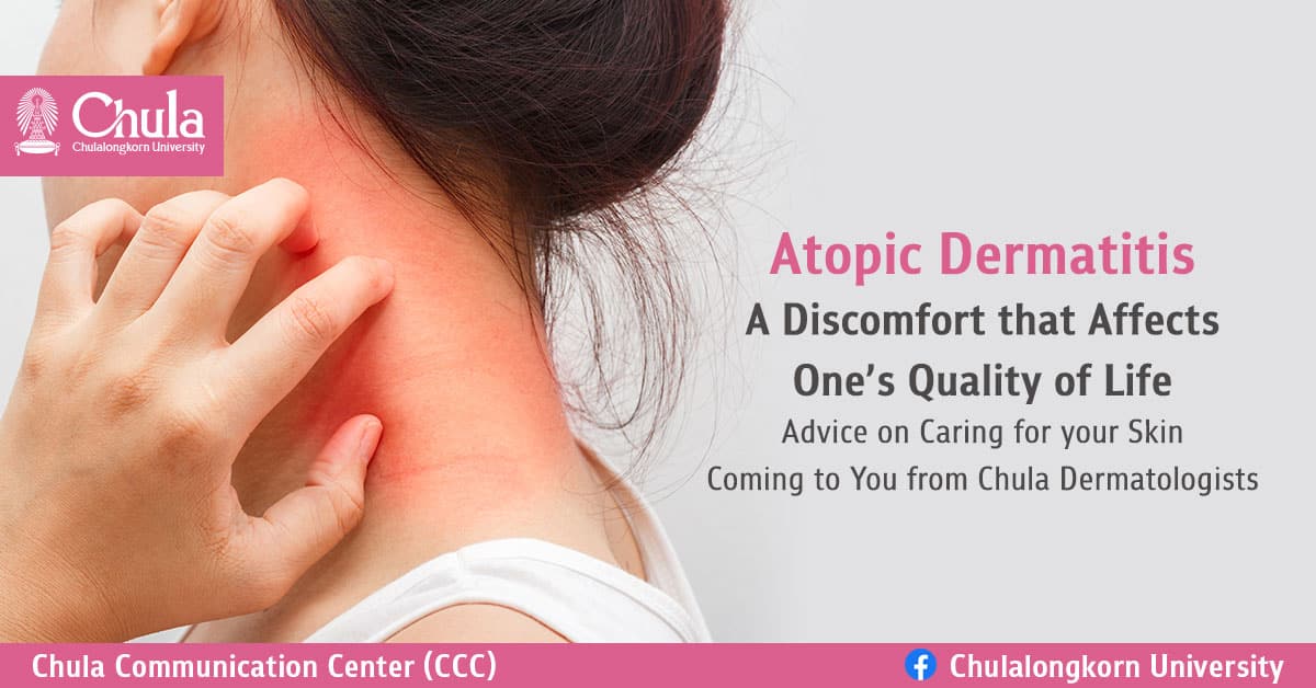 “Atopic Dermatitis”: A Discomfort that Affects One’s Quality of Life Advice on Caring for your Skin Coming to You from Chula Dermatologists