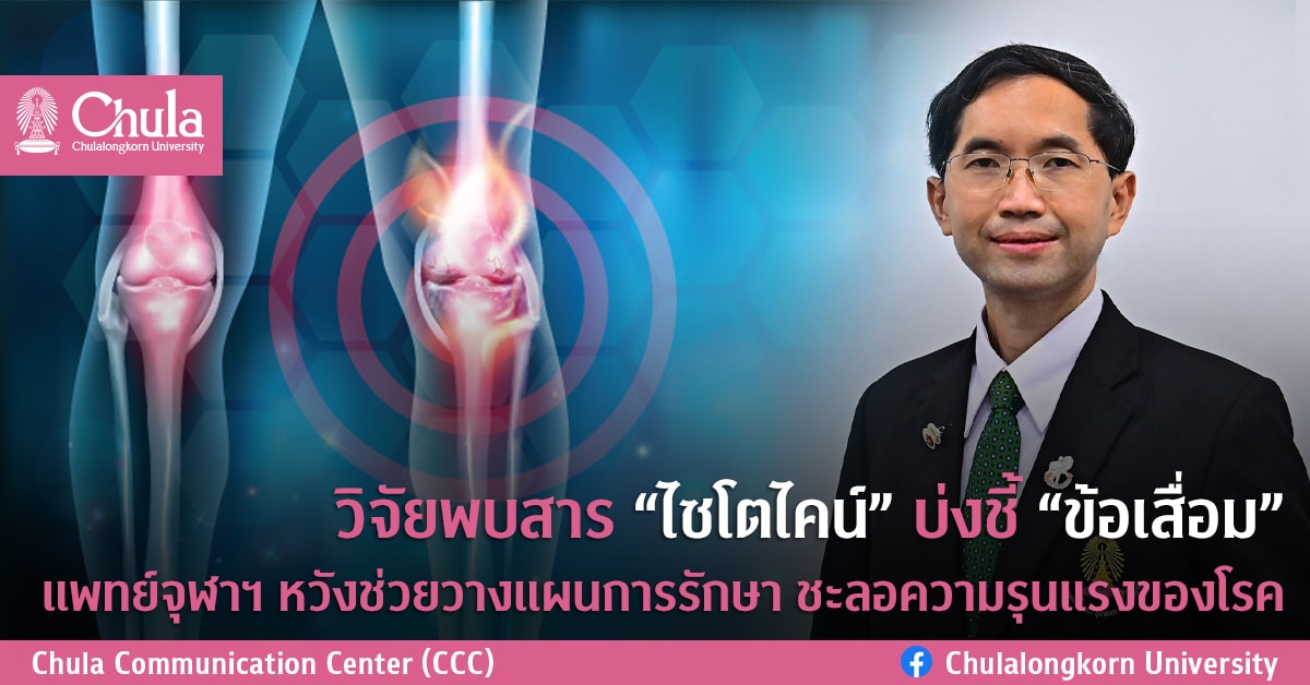 วิจัยพบสาร “ไซโตไคน์” บ่งชี้ “ข้อเสื่อม” แพทย์จุฬาฯ หวังช่วยวางแผนการรักษา ชะลอความรุนแรงของโรค
