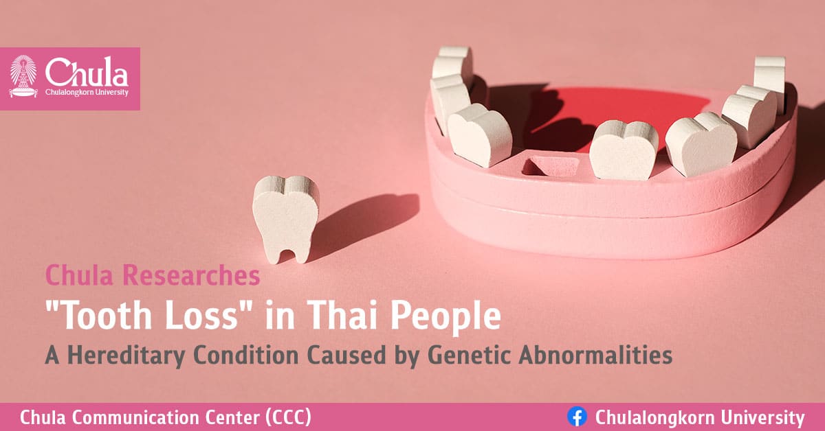 Chula Researches “Tooth Loss” in Thai People- A Hereditary Condition Caused by Genetic Abnormalities
