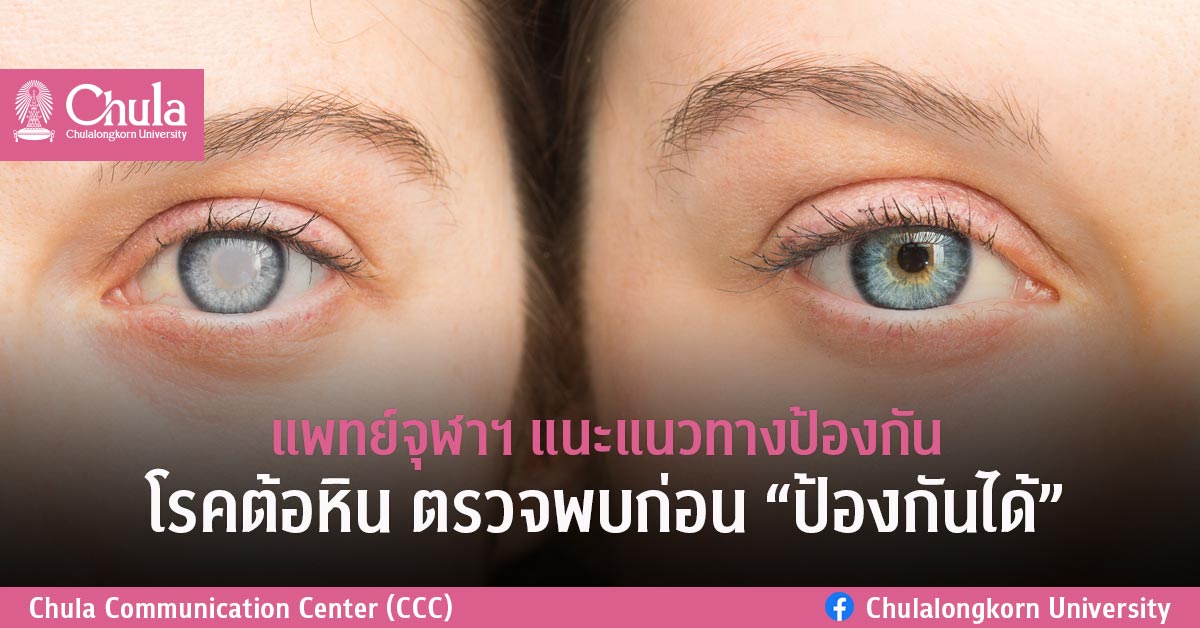 แพทย์จุฬาฯ แนะแนวทางป้องกันโรคต้อหิน ตรวจพบก่อน “ป้องกันได้”