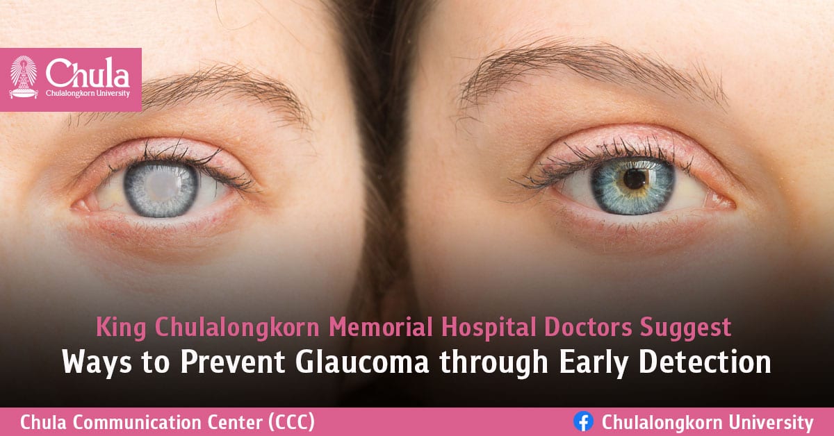King Chulalongkorn Memorial Hospital Doctors Suggest Ways to Prevent Glaucoma through Early Detection