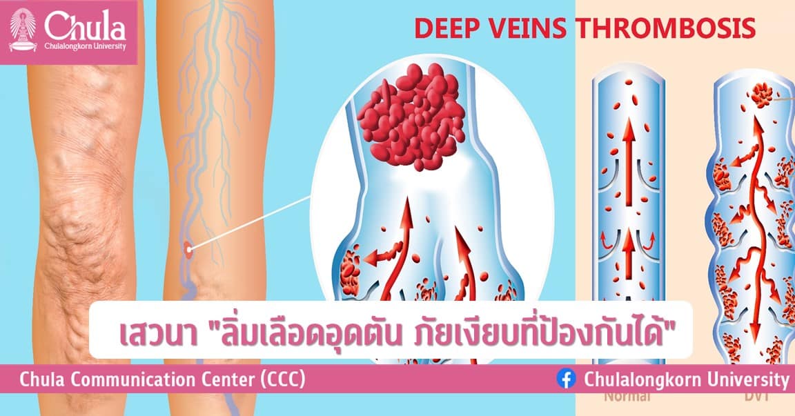 เสวนา “ลิ่มเลือดอุดตัน ภัยเงียบที่ป้องกันได้”