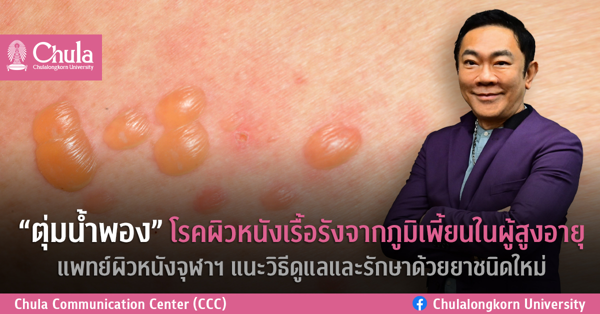 “ตุ่มน้ำพอง” โรคผิวหนังเรื้อรังจากภูมิเพี้ยนในผู้สูงอายุ แพทย์ผิวหนังจุฬาฯ แนะวิธีดูแลและรักษาด้วยยาชนิดใหม่