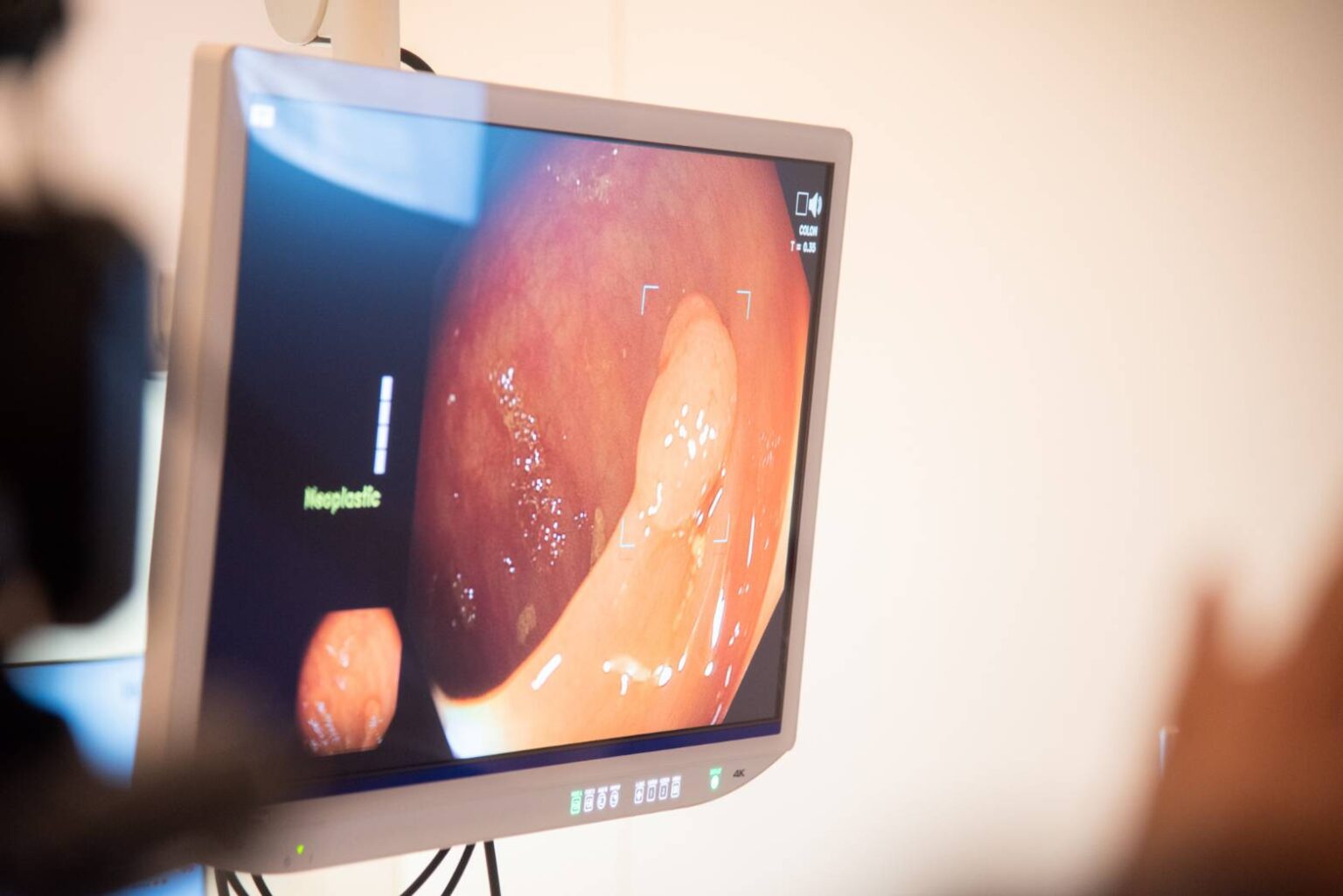 ��DeepGI�� �� AI-Assisted GI Endoscopy for Accurate Colorectal Cancer, a Collaboration between Chulalongkorn��s Engineers and Doctor, Shines at ENDO 2024 in South Korea 