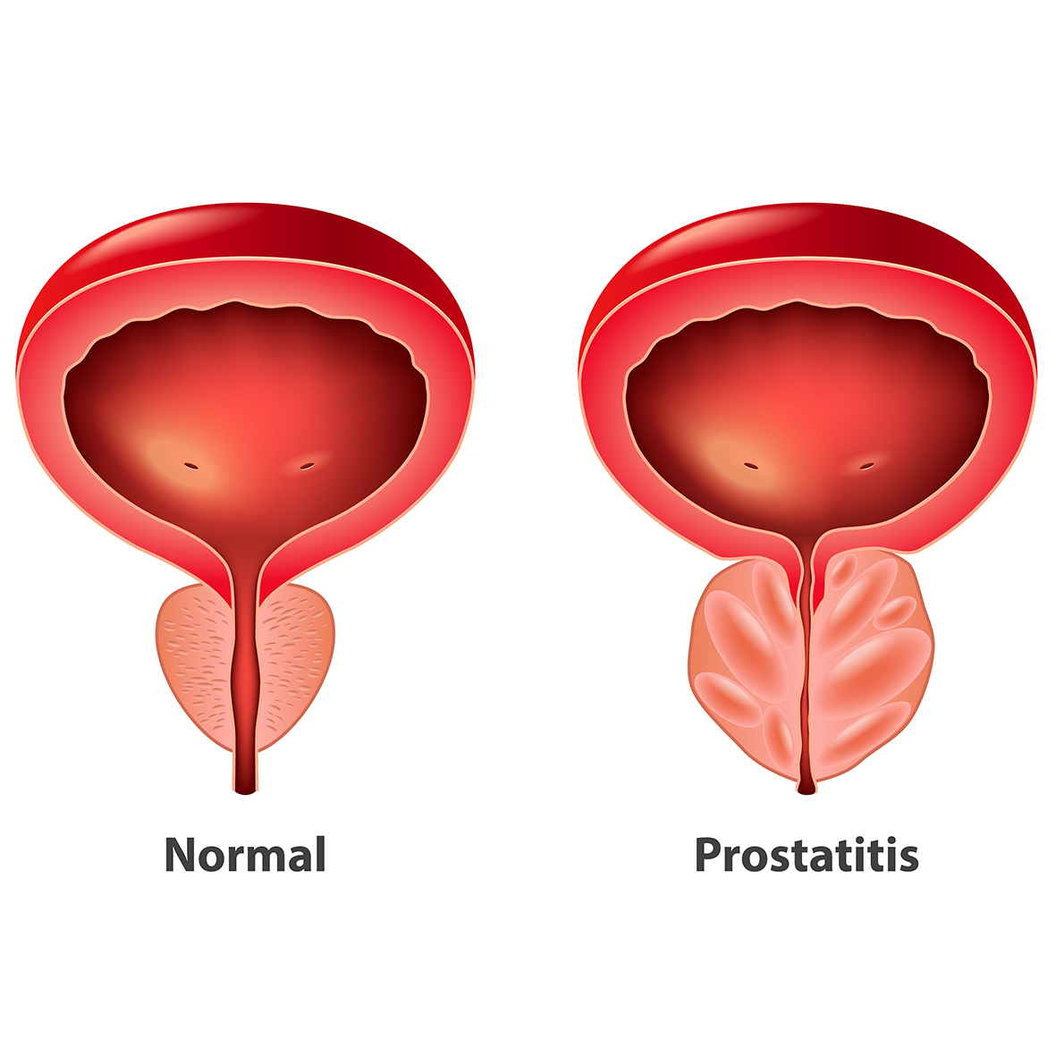 Thai Herbs “Crinum Plants – Black Galingale”: A New Alternative to Reduce the Risk of Prostate Enlargement by Chula Research Team