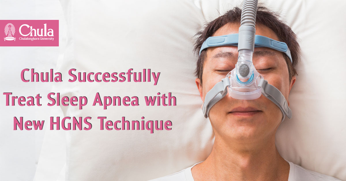 Chulalongkorn University doctors successfully performed surgery for obstructive sleep apnea using the new HGNS technique: the fourth successful surgery of this kind in Asia 