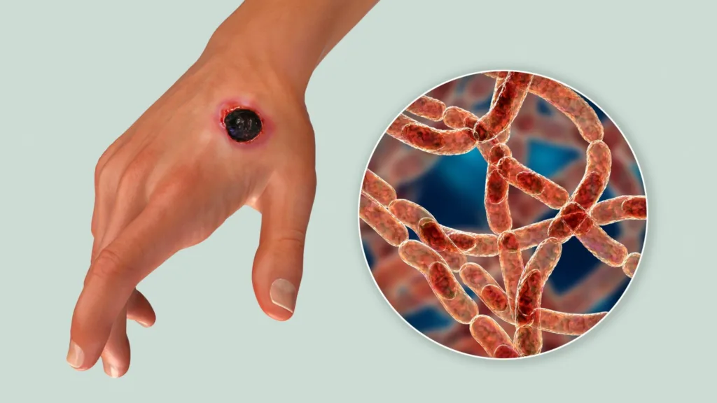 The initial symptom: the wound has a distinctive appearance known as an ��eschar��.