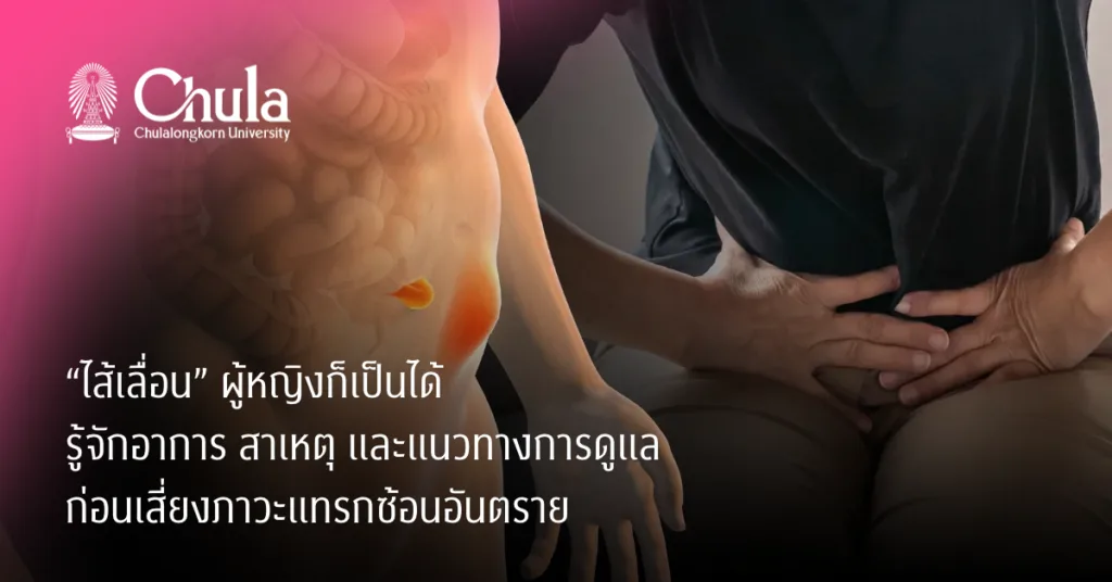 “ไส้เลื่อน” ผู้หญิงก็เป็นได้ รู้จักอาการ สาเหตุ และแนวทางการดูแล ก่อนเสี่ยงภาวะแทรกซ้อนอันตราย